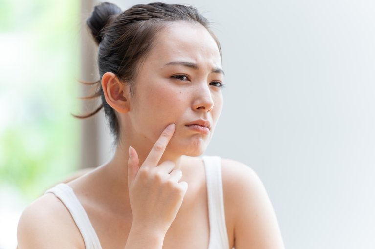 にきび・毛穴の開きにお悩みではございませんか?
